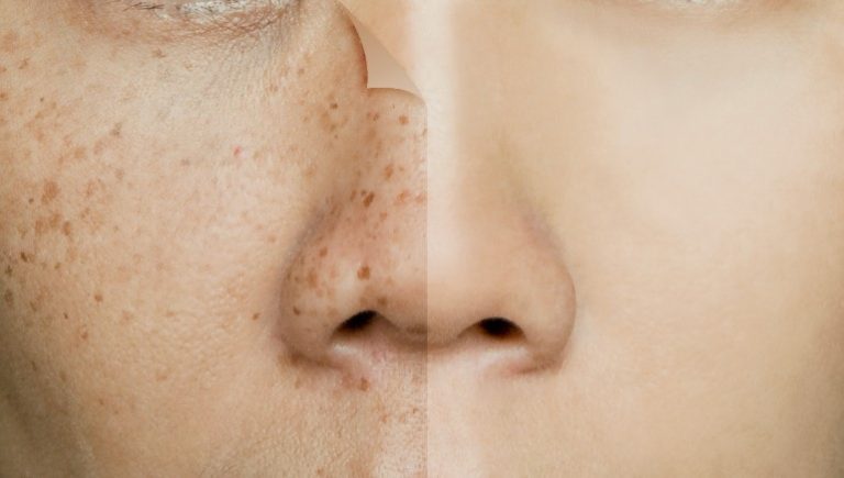 skin pigmentation