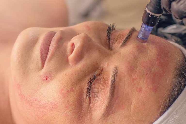 microneedling-treatment