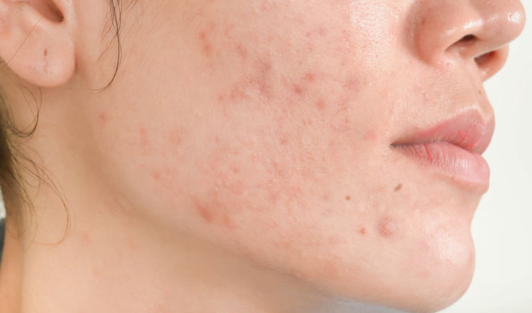acne scars