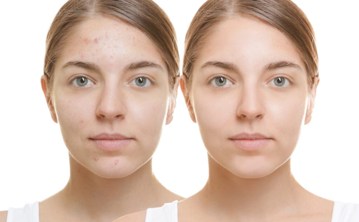 Beautiful young woman with problem skin on white background