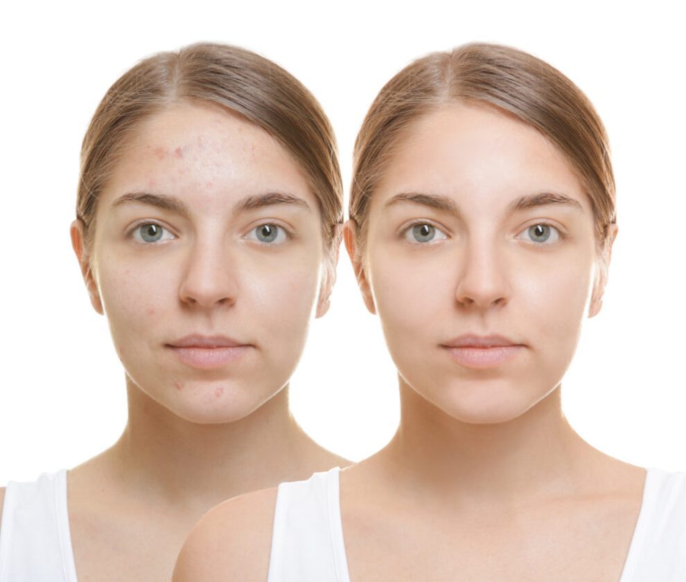 Beautiful young woman with problem skin on white background