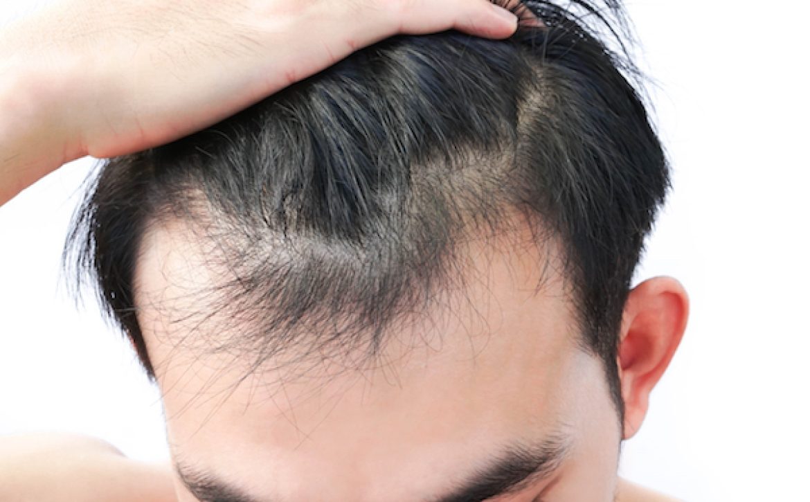 Close-Up Of Man With Receding Hairline Against White Background