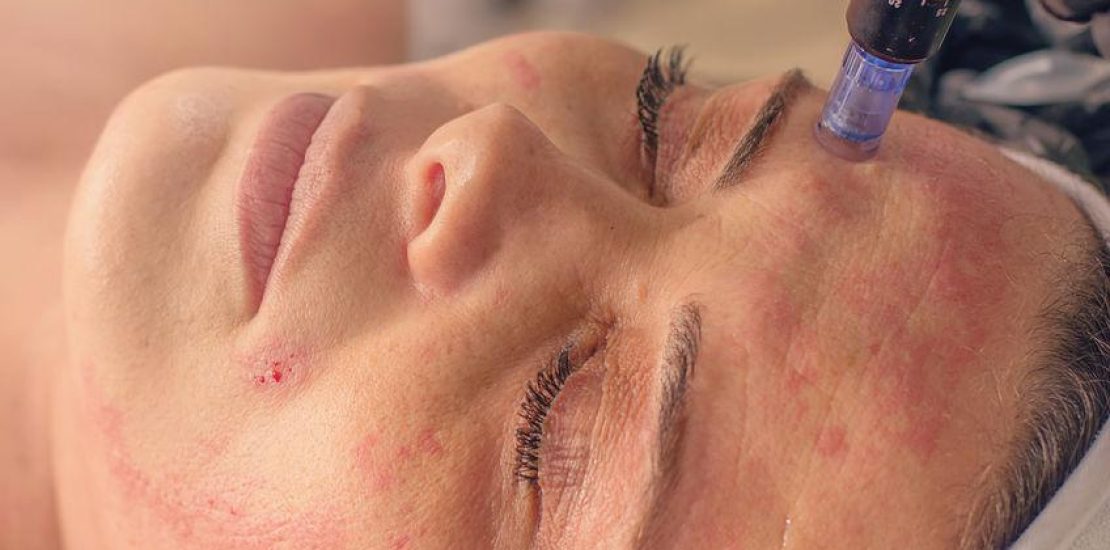 microneedling-treatment